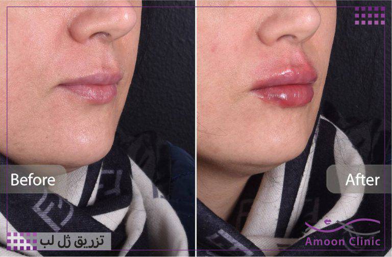 نمونه قبل و بعد زیبایی 17 قبل و بعد تزریق ژل لب از نمای نیمرخ