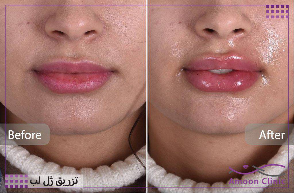 تزریق ژل لب