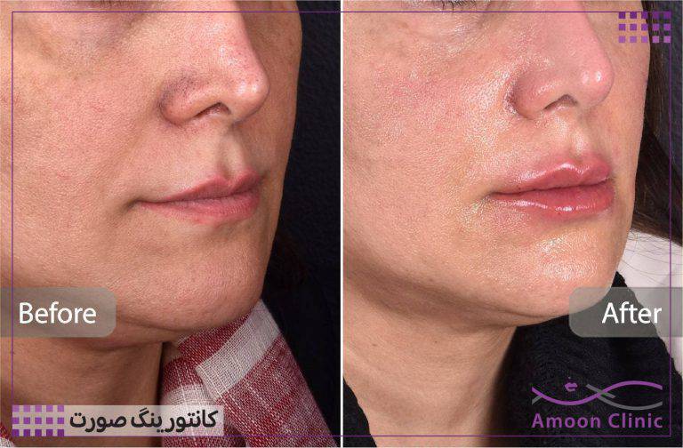 نمونه قبل و بعد زیبایی 57 قبل و بعد زاویهسازی صورت و برجسته شدن گونه