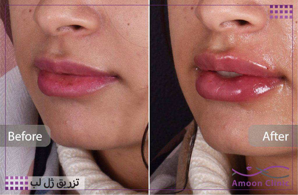تزریق فیلر لب