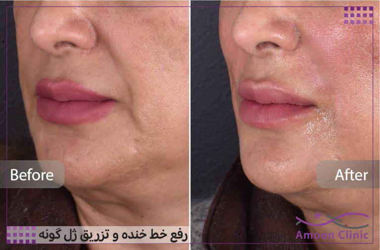 نمونه قبل و بعد زیبایی 33 قبل و بعد تزریق ژل خط خنده در سنین بالاتر