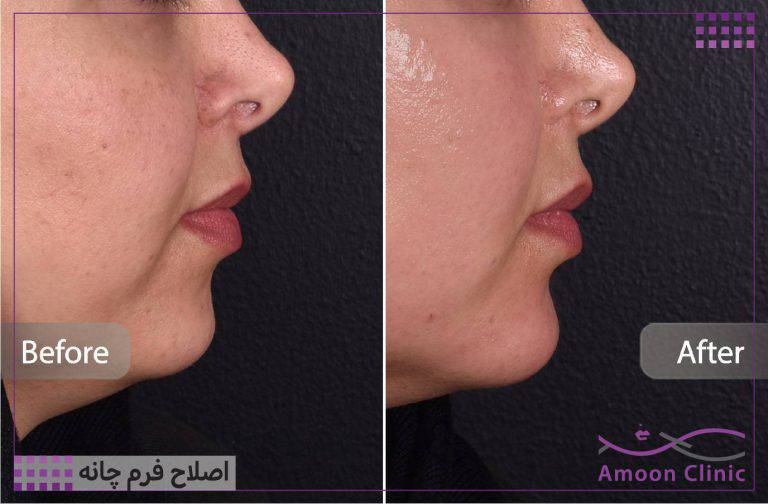 نمونه قبل و بعد زیبایی 44 قبل و بعد تزریق ژل چانه از نیمرخ و کشیدگی زیر چانه