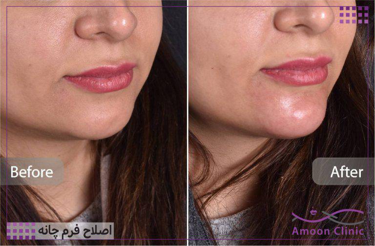 نمونه قبل و بعد زیبایی 46 قبل و بعد ژل چانه از زاویه سهرخ