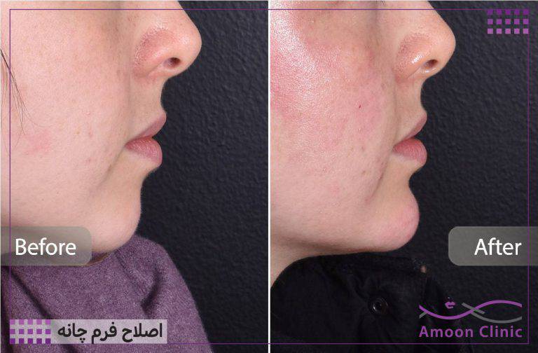 نمونه قبل و بعد زیبایی 47 قبل و بعد تزریق فیلر چانه و اصلاح پروفایل صورت