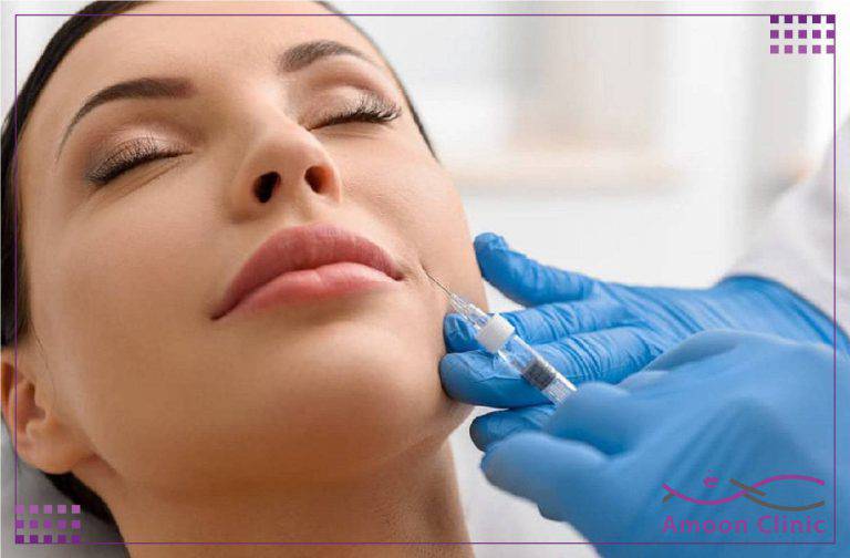 تزریق ژل خط خنده 5 تزریق فیلر خط خنده روی گونه در کلینیک آمون