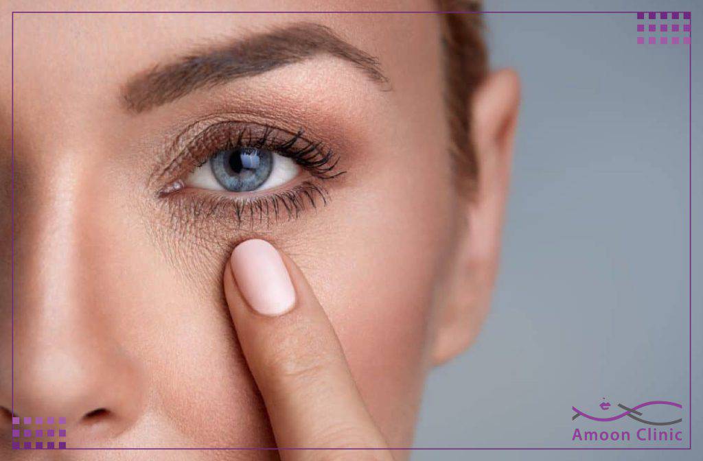 تزریق ژل زیر چشم