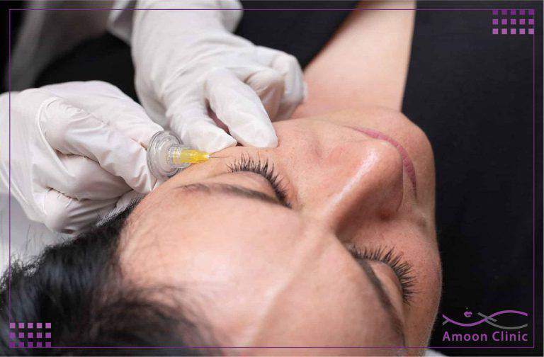 کربوکسی تراپی 3 کربوکسی تراپی تیرگی
