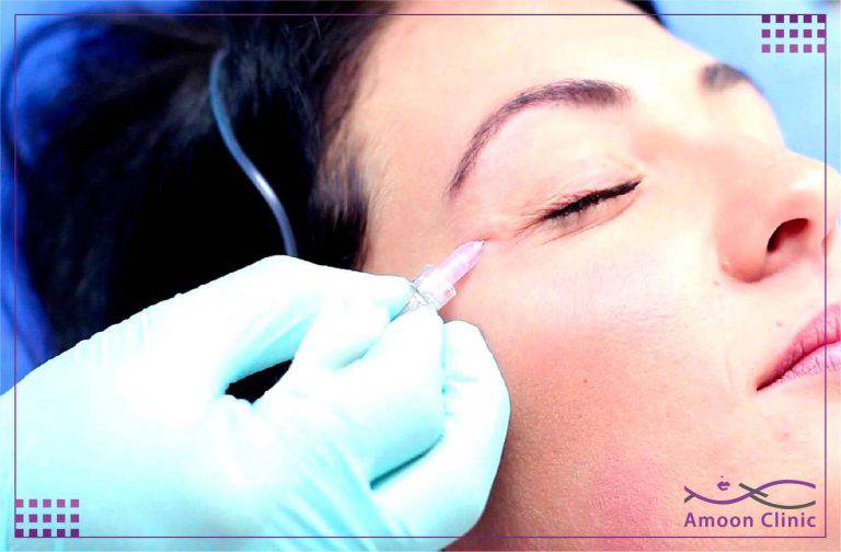 کربوکسی تراپی 5 عکس قبل و بعد کربوکسی تراپی برای جوانسازی صورت