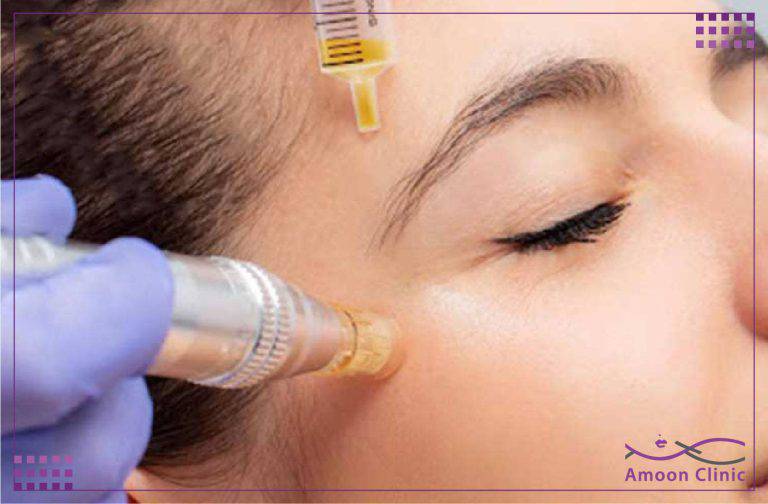 روش های جدید جوانسازی پوست 4 جوانسازی پوست مزونیدلینگ