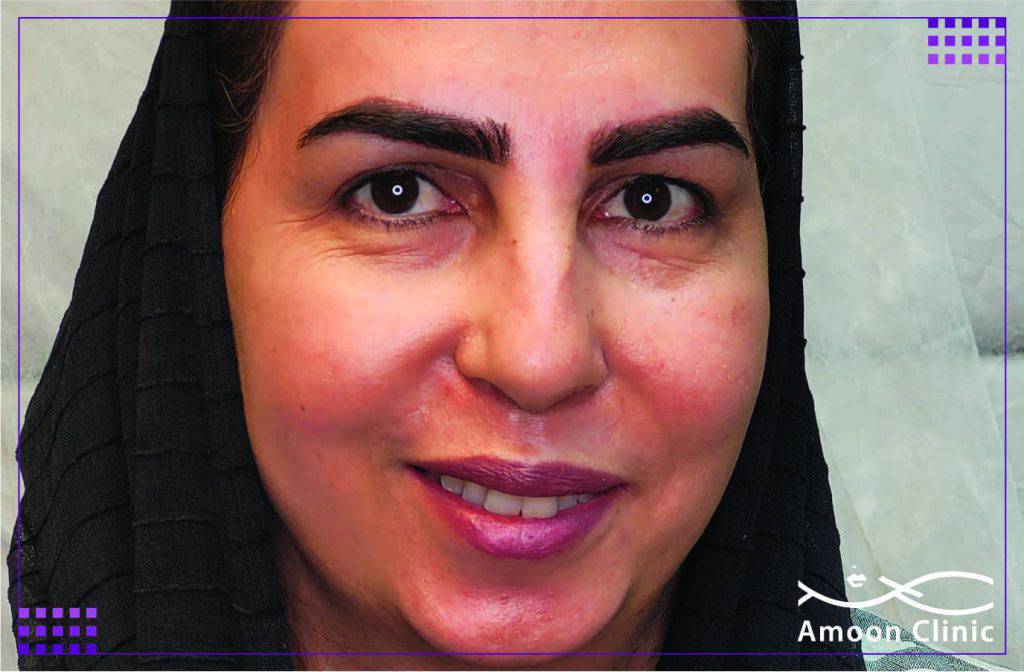 کاشت ابرو طبیعی
