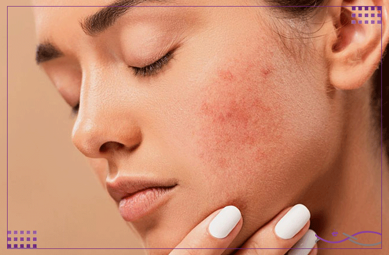 مزونیدلینگ صورت | فواید، عوارض و مراقبتها 1 مزونیدلینگ برای جای جوش
