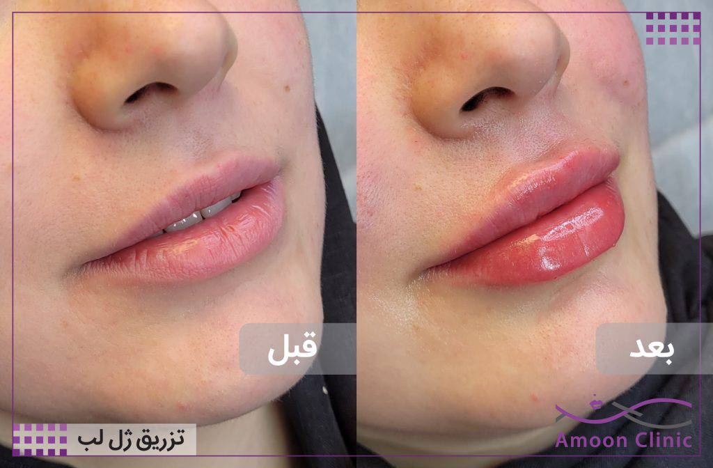 تزریق ژل لب طبیعی