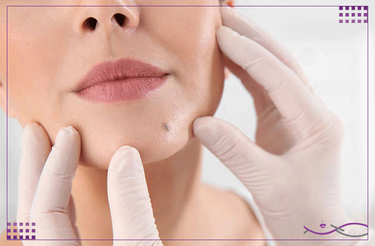 مراقبتهای بعد از برداشت خال و یا هر نوع ضایعه پوستی 1 مراقبتهای بعد از برداشت خال