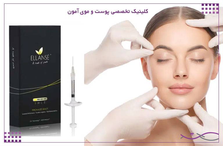 تزریق ژل الانسه: کیفیت، ماندگاری، عوارض و مزایا 2 تزریق ژل الانسه به صورت