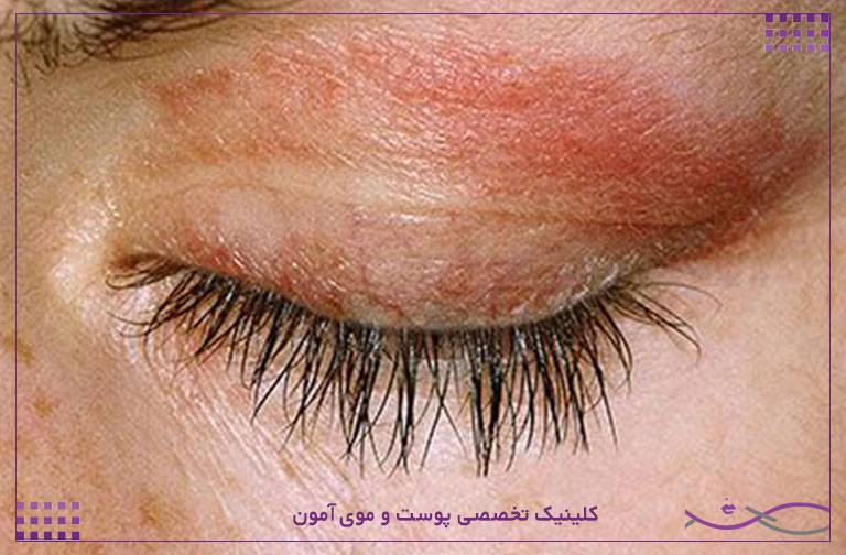 عوارض کاشت مژه و اکستنشن مژه برای چشم و پوست 3 التهاب و قرمزی مزمن پلک