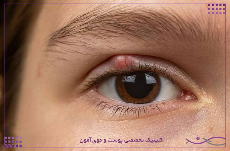 عوارض کاشت مژه و اکستنشن مژه برای چشم و پوست 2 عفونت پلک گل مژه