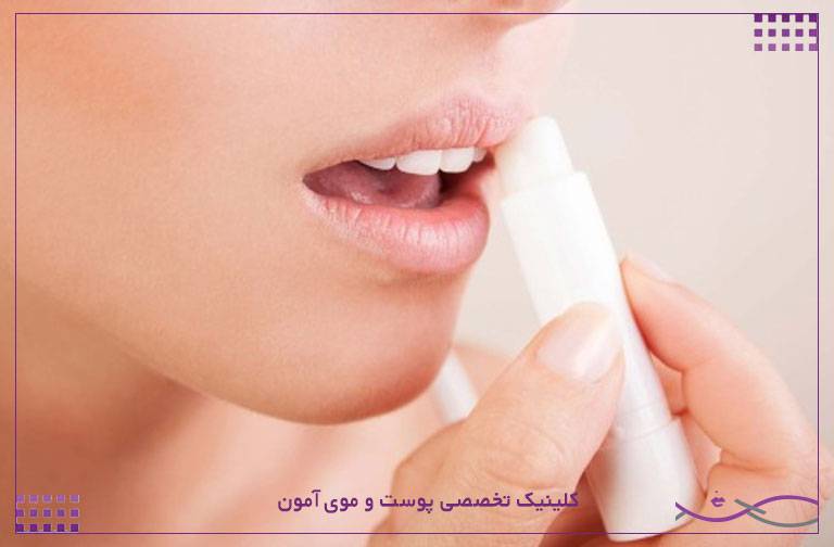 خشکی لب چیست و چگونه ترک و خشکی لبها را درمان کنیم؟ 1 بالم لب
