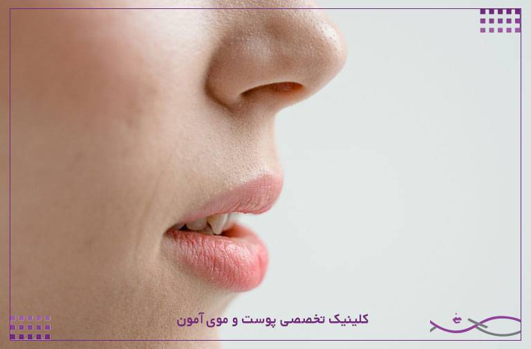 خشکی لب