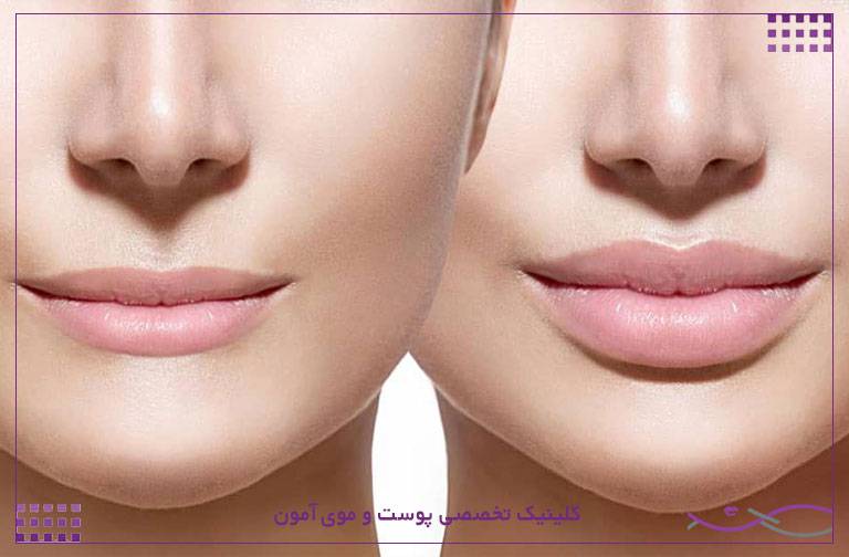 سانترال لب چیست؟ هرآنچه باید درباره لیفت لب بدانید 2 سانترال لب