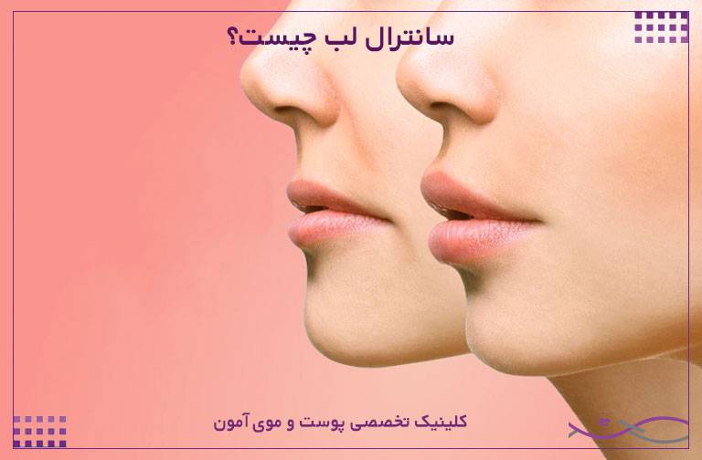 مقایسه نیمرخ لب قبل و بعد از لیفت لب سانترال