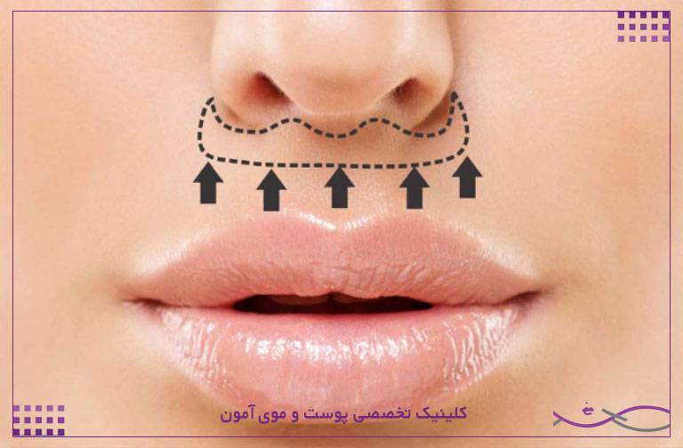 سانترال لب چیست؟ هرآنچه باید درباره لیفت لب بدانید 1 سانترال لب
