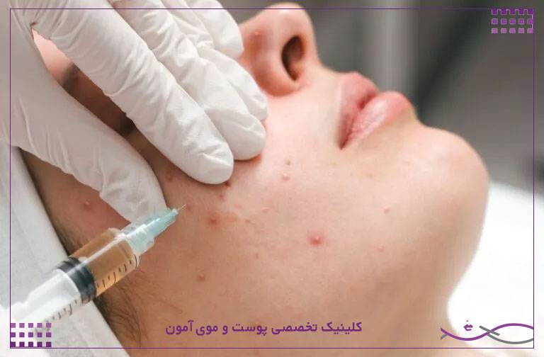درمان لک صورت با مزوتراپی 1 درمان لک صورت با مزوتراپی