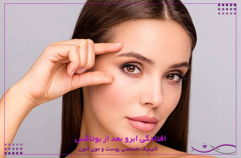 افتادگی ابرو بعد از بوتاکس