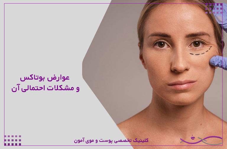 عوارض بوتاکس و مشکلات احتمالی آن