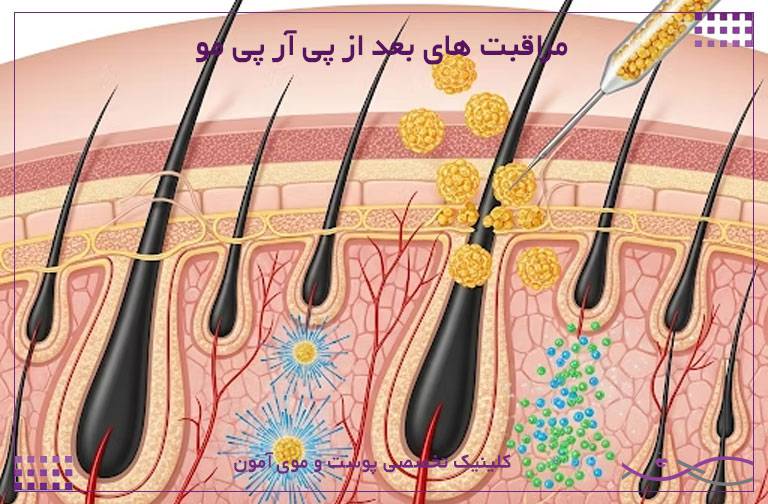 مراقبت های بعد از پی آر پی مو 1 مراقبت های بعد از پی آر پی مو.2