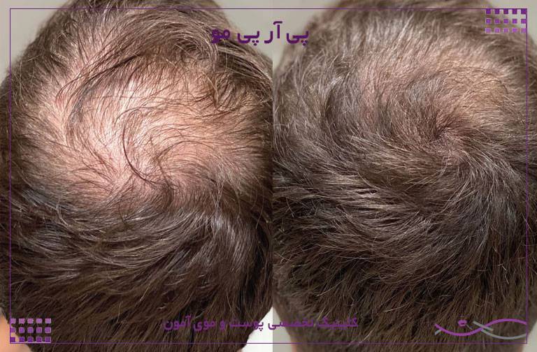 پی آر پی مو سر
