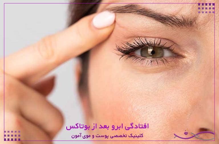 افتادگی ابرو بعد از بوتاکس
