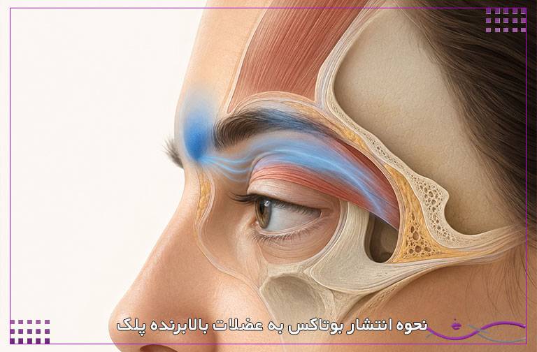افتادگی پلک بعد از بوتاکس 1 نحوه انتشار بوتاکس به عضلات بالابرنده پلک