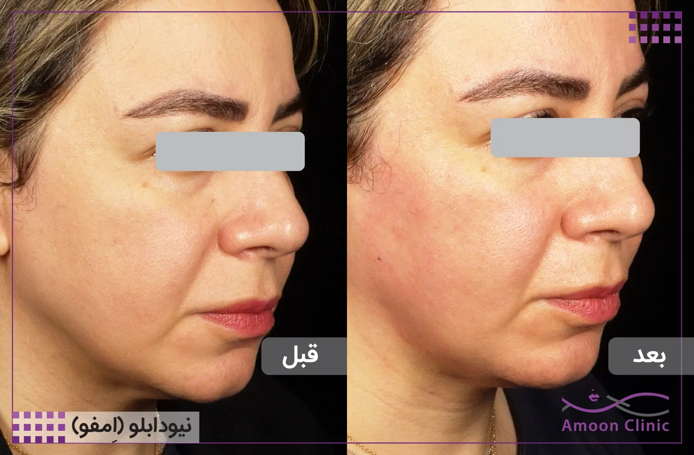 امفوتراپی MFU New Doublo 2.0 7 قبل و بعد امفوتراپی — رفع شلی گونه و فرمدهی خط فک، نمای سهرخ