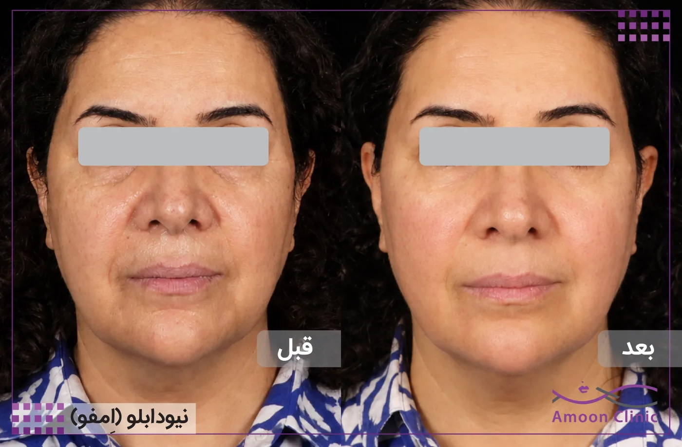 امفوتراپی MFU New Doublo 2.0 6 قبل و بعد امفوتراپی — سفت شدن پوست صورت و فرمدهی خط فک، نمای روبهرو