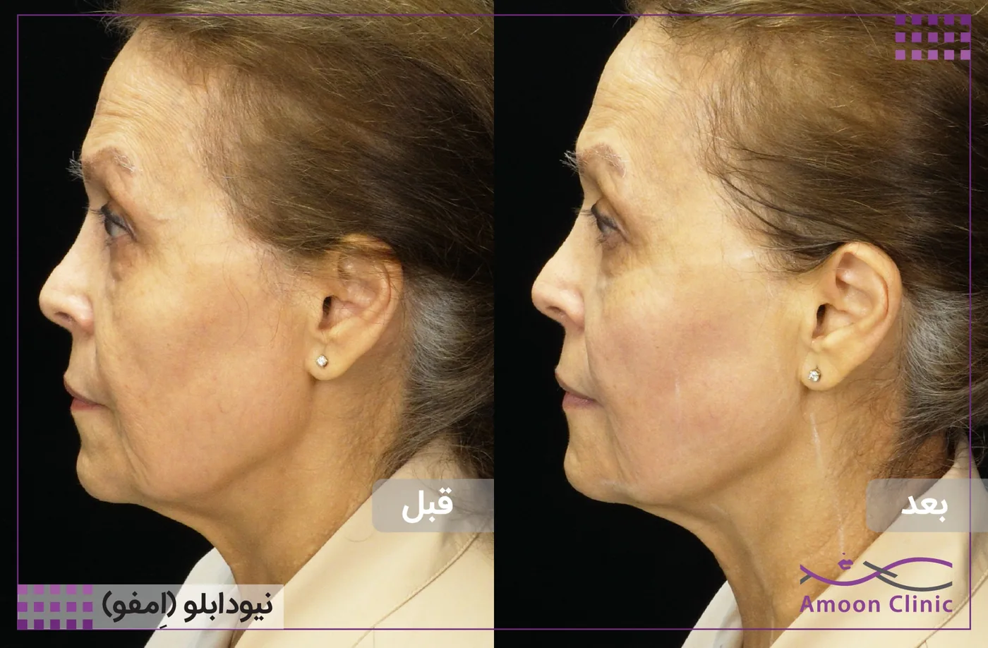 امفوتراپی MFU New Doublo 2.0 5 قبل و بعد امفوتراپی با دستگاه نیودابلو — لیفت و رفع شلی پوست صورت و غبغب، نمای نیمرخ