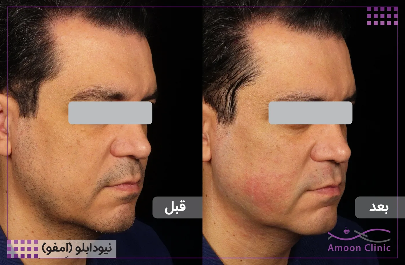 امفوتراپی MFU New Doublo 2.0 8 قبل و بعد امفوتراپی در آقایان — رفع شلی پوست صورت و خط فک